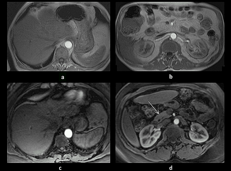 Figure 2: Early subphases of enhancement. The early hepatic arterial phase (EHAP) was observed on transverse 2D-GE images