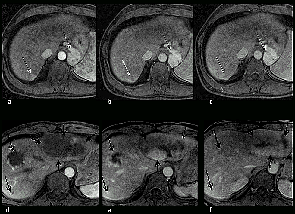 Figure 3: A cirrhotic patient evaluated for possible HCC (a  c) and a patient evaluated for indeterminate liver mass (d  f).