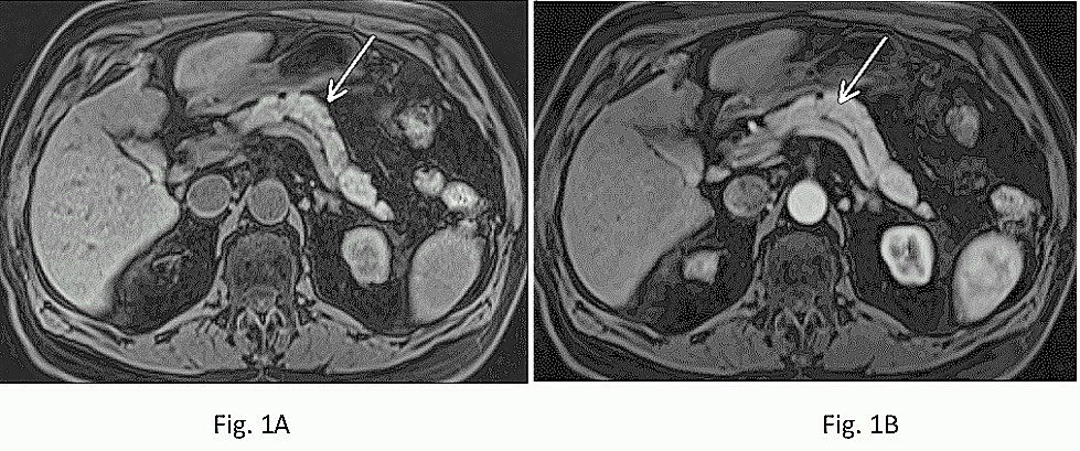 Figure 1: Normal pancreas. T1-weighted fat-suppressed SGE (A)
