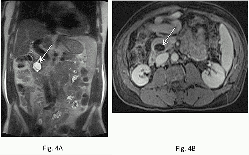 Figure 4: Side-branch type IPMT. Coronal T2-weighted single shot echo trains spin echo (A) and axial post-gadolinium fat-suppressed T1-weighted gradient echo (B) images demonstrate mainly large cystic side branch lesion in the head of the pancreas (arrow).