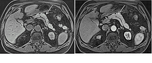 Figure 1: Normal pancreas. T1-weighted fat-suppressed SGE (A),