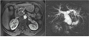 Figure 2: Pancreatic adenocarcinoma arising in the head. Transverse immediate post-contrast fat-suppressed T1-weighted 3D-GE (A) and coronal oblique thick-section MRCP (B) images. On immediate postcontrast image (A), the tumor is well shown as a low signal intensity mass (arrow). The MRCP image (B) demonstrates obstruction of the common bile duct and pancreatic duct, creating the double duct sign.